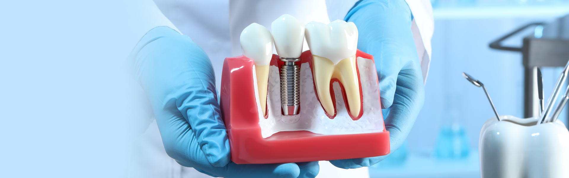 The Adverse Effects of Caffeine on the Stability of Dental Implants
