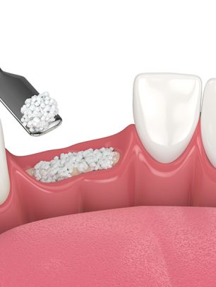 When Bone Grafts Go Wrong: Causes of Failure