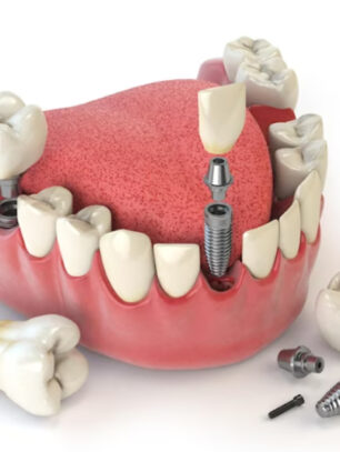 Dentures