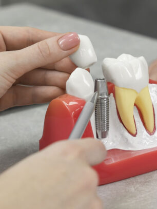 What to Expect During Dental Implant Recovery