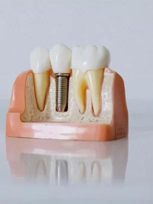 Dental Implant Maintenance: How to Protect Your Investment